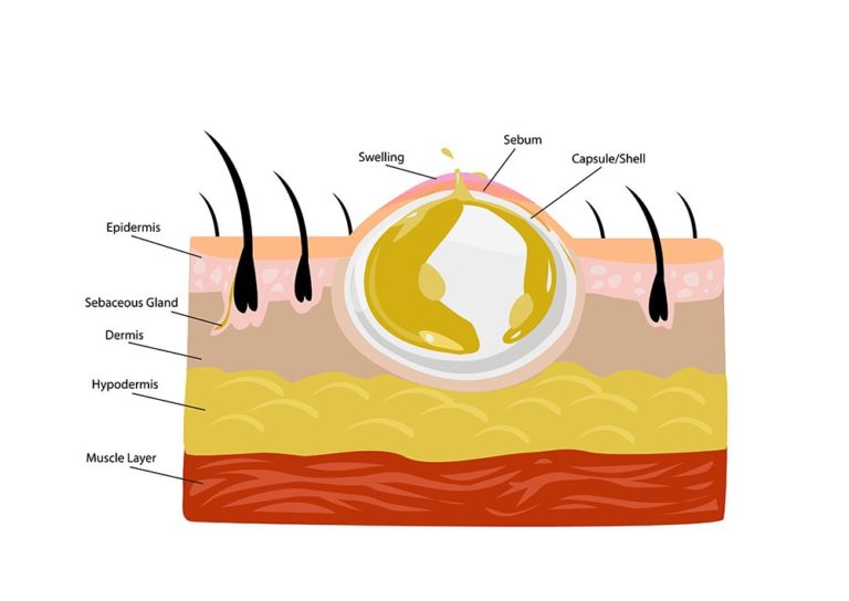 Abscess Drainage » Palmer General Surgeon | Mat-Su Surgical Associates ...