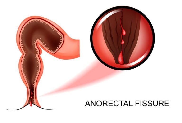 Can anal fissure cause severe bleeding