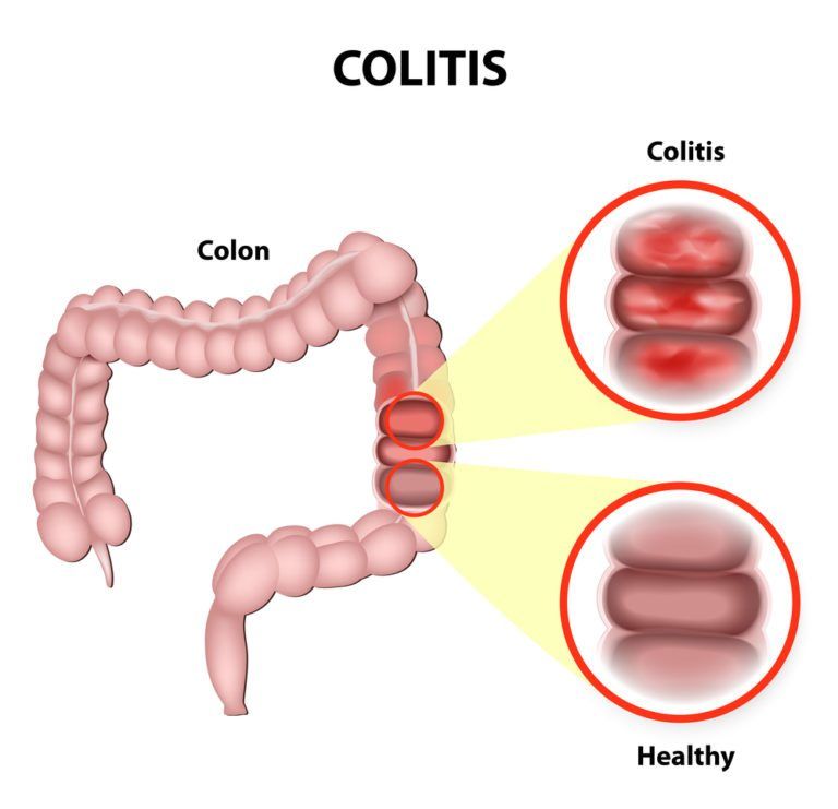 ulcerative-colitis-palmer-general-surgeon-mat-su-surgical