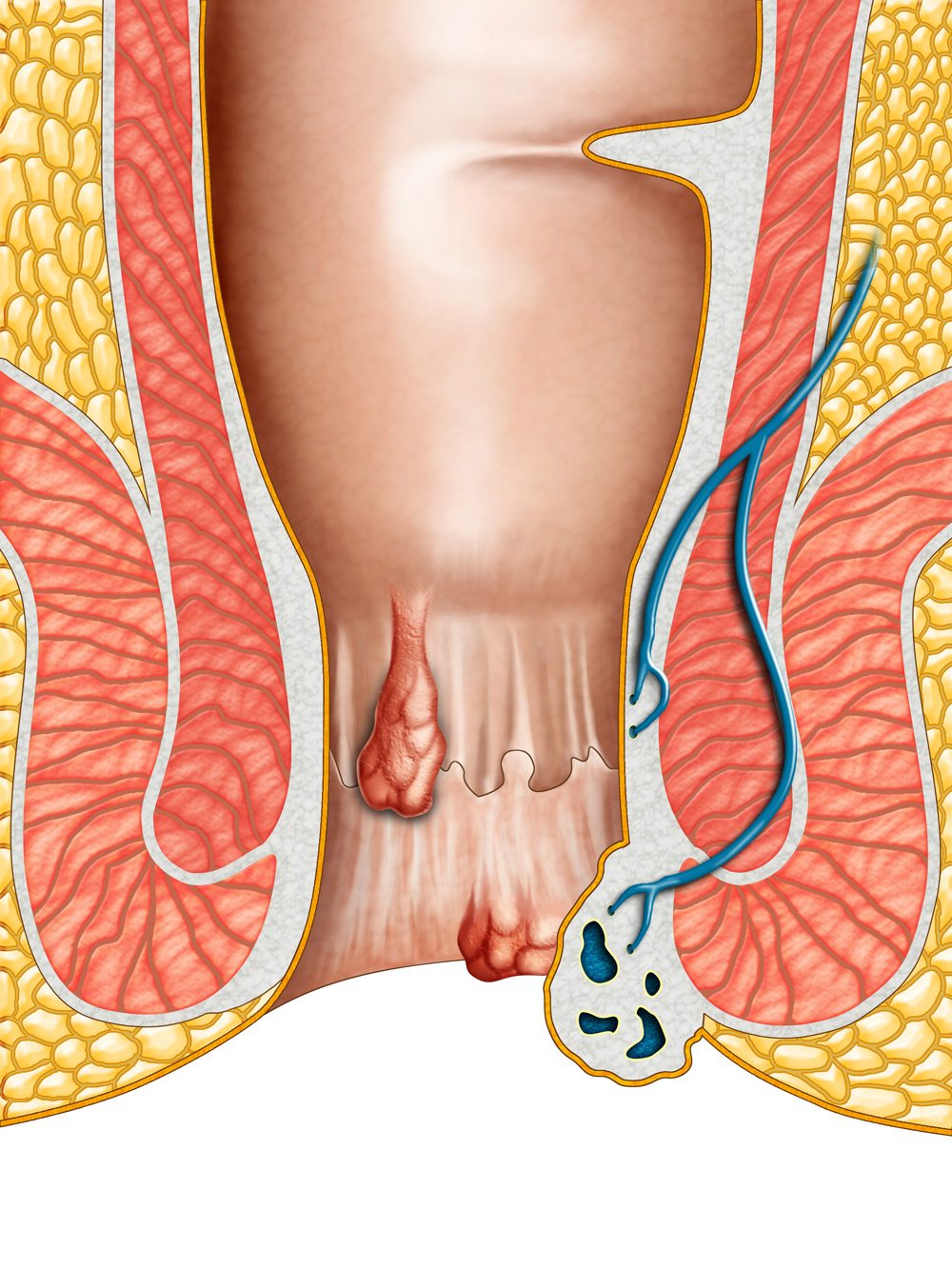 can you take semaglutide with one kidney Semaglutide 1.0 mg (Ozempic) Reduced Kidney Events 24% in FLOW Trial